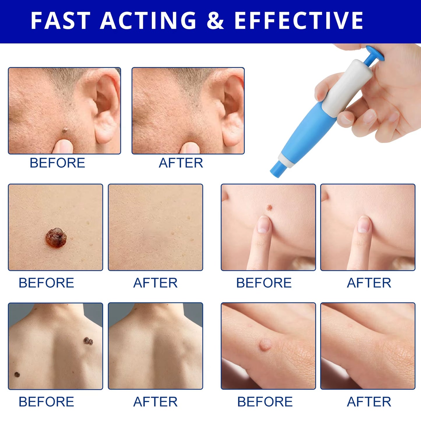 High Quality Best Products Moles and Wart Remover Face Body Skin Tags Removal Pen