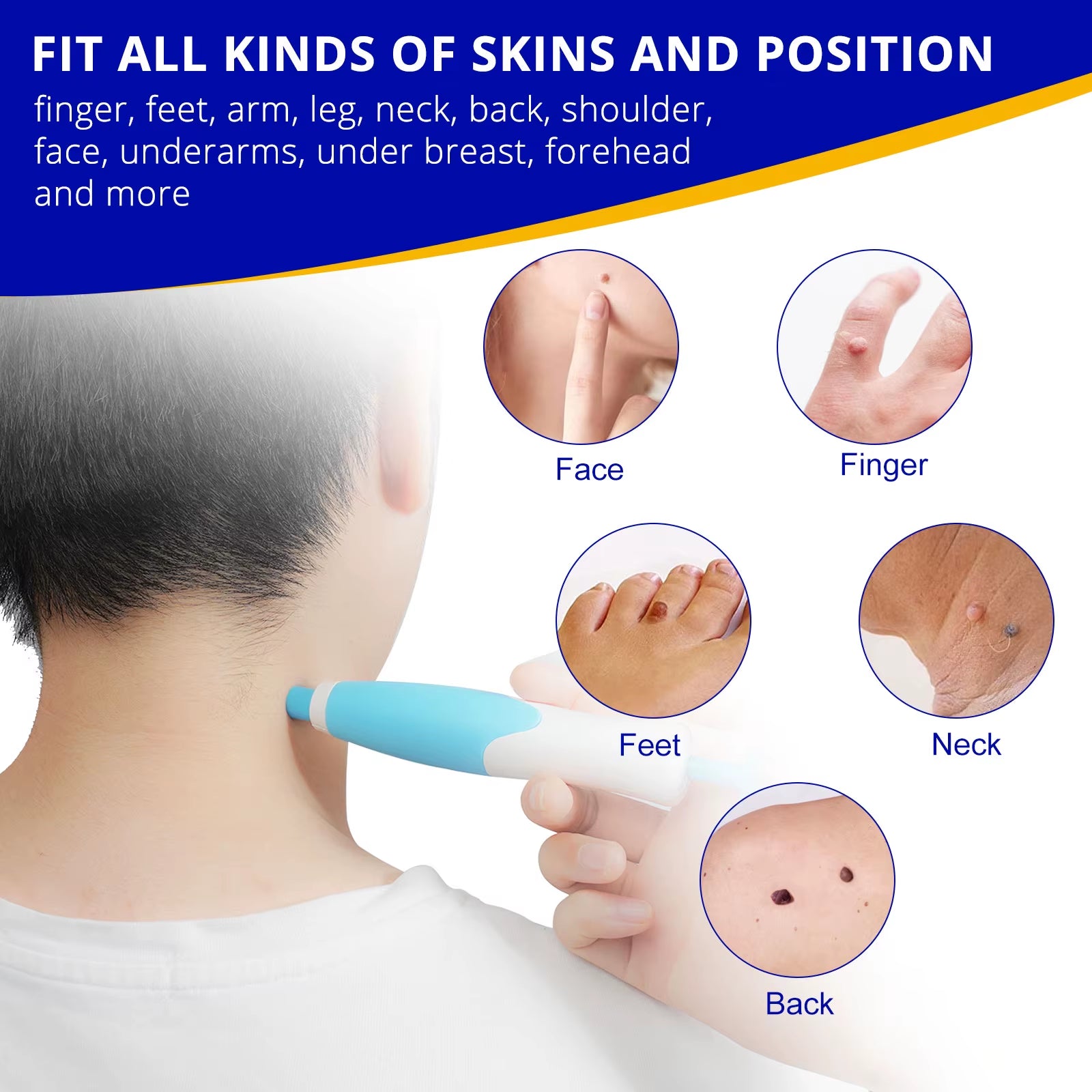 High Quality Best Products Moles and Wart Remover Face Body Skin Tags Removal Pen